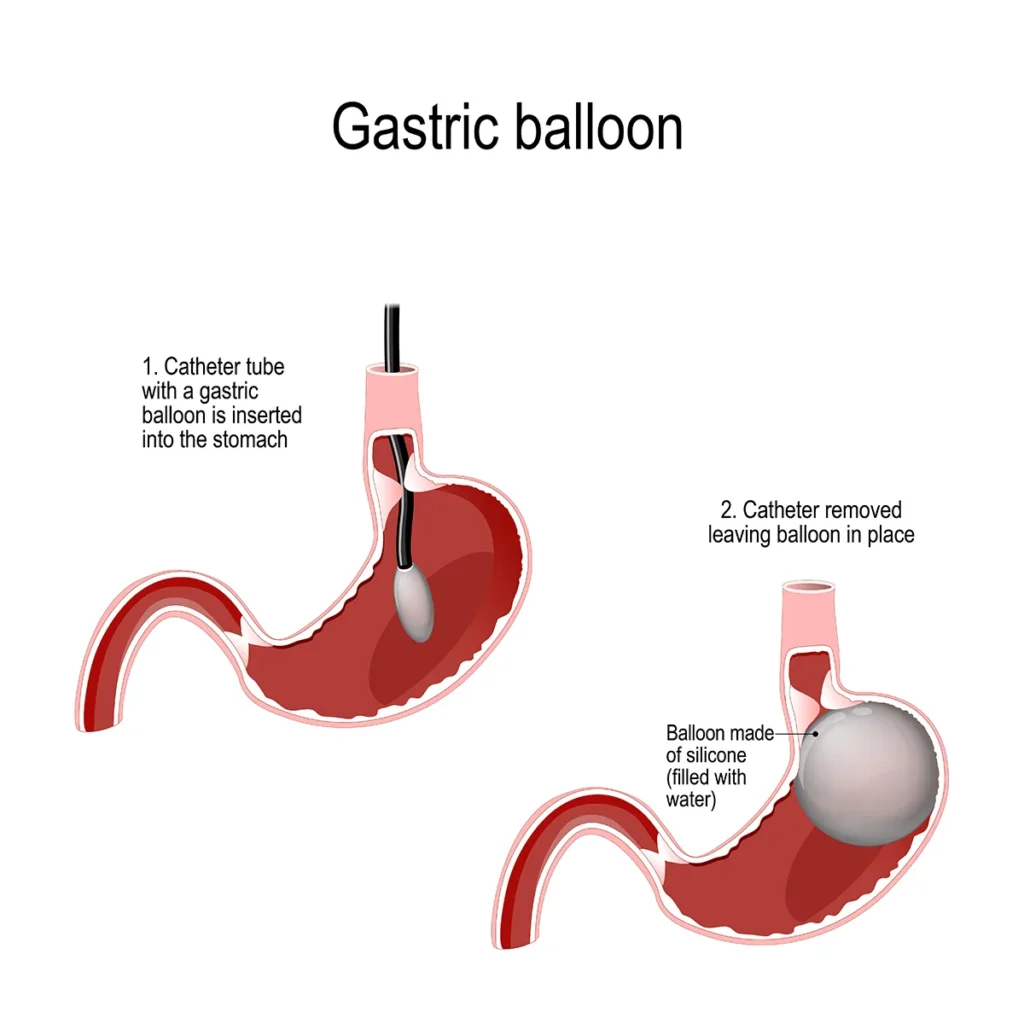 Gastric Balloon
